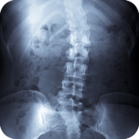 scoliosis-spine-xray